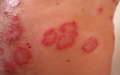 Keto Rash